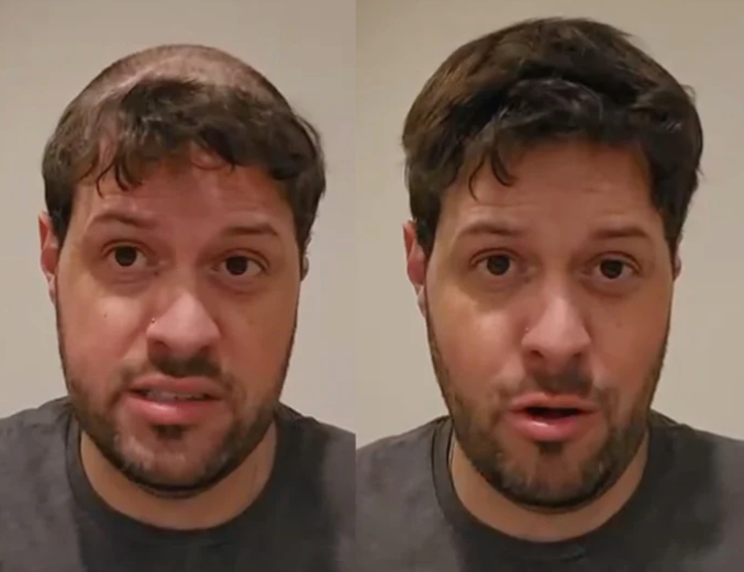 Discover Confidence with Lyrical Hair: Premium Hair Systems for Men