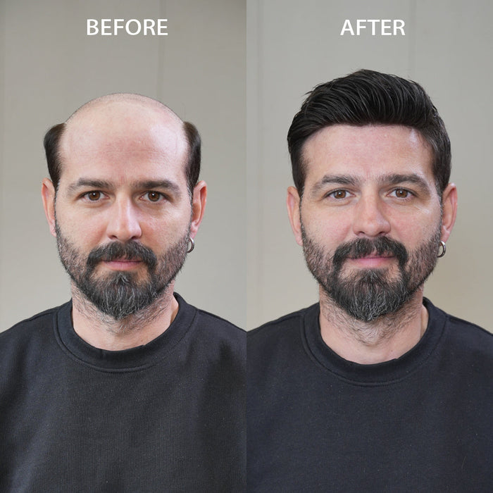 7 Signs You Need a Hair System (And How to Spot Them Early)