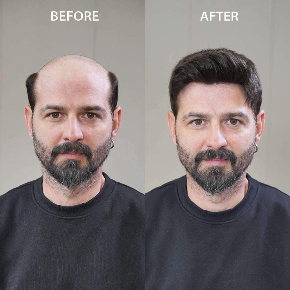 Bid Farewell to “Balding Anxiety” — Lyrical Hair Men’s Hair System Restores Confidence Instantly