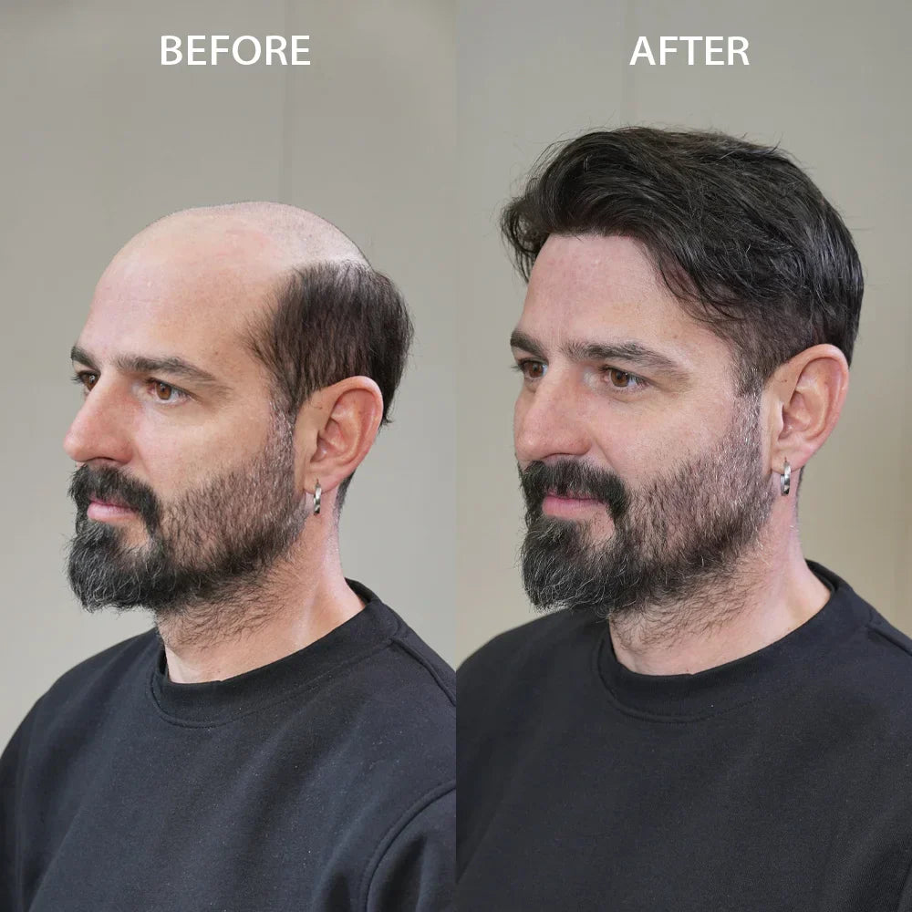 Why Lyrical Hair Mens Toupee Is the Best Choice for Hair Loss Men