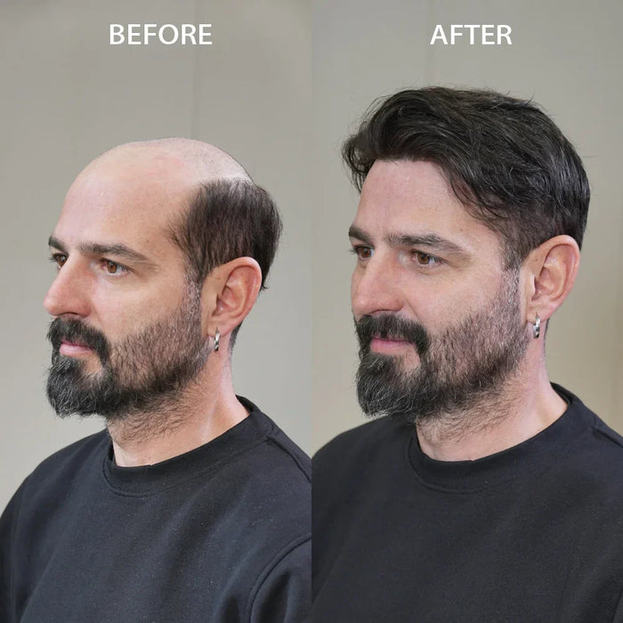 Why Lyrical Hair Mens Toupee Is the Best Choice for Hair Loss Men