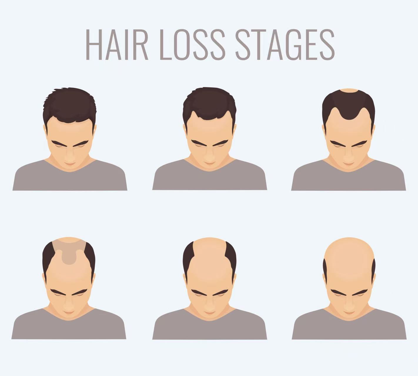 Why Hair Systems Are the Most Efficient Hair Loss Solution for Men