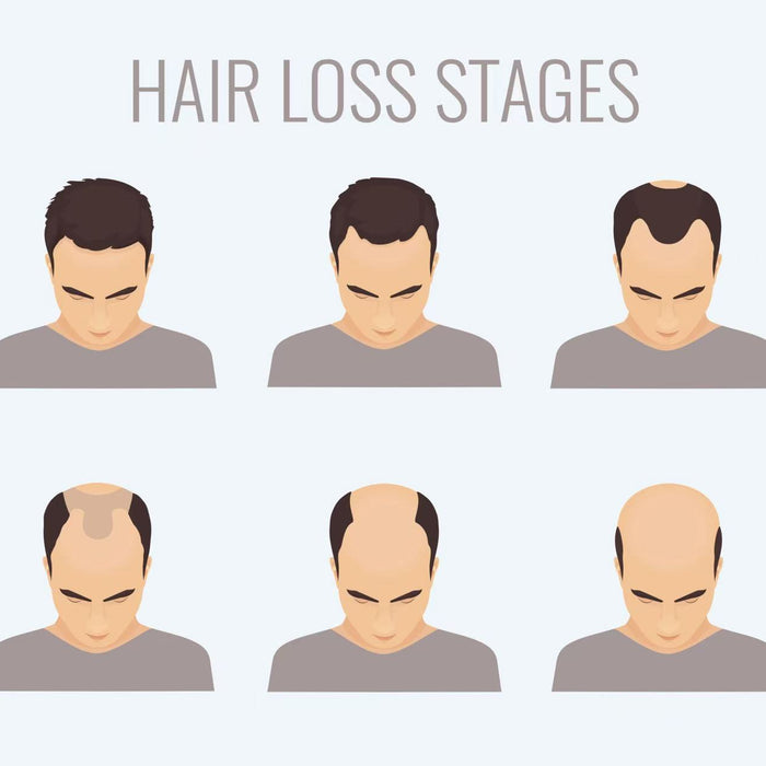 Why Hair Systems Are the Most Efficient Hair Loss Solution for Men