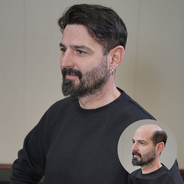 Thinning Crown Bald Spots? How a Hair System Covers Hard-to-Fix Areas