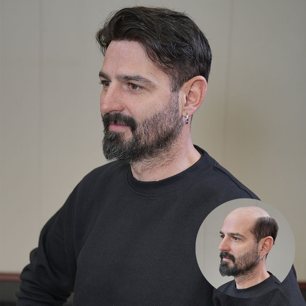 Why So Many Men Give Up on Medications and Choose Non-Surgical Hair Systems