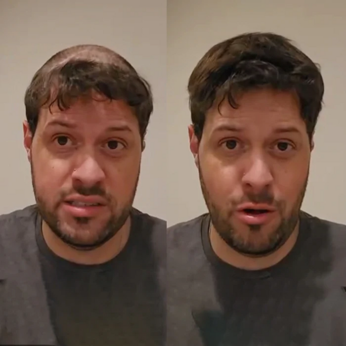 A Simple, Smart Answer to Hair Loss in 2026